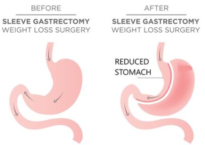 Bariatric surgery before and after