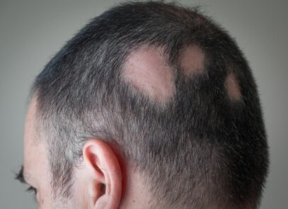 Alopecia Areata Ayurvedic Treatment