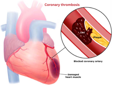 Coronary thrombosis