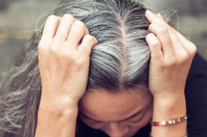 premature greying of hair